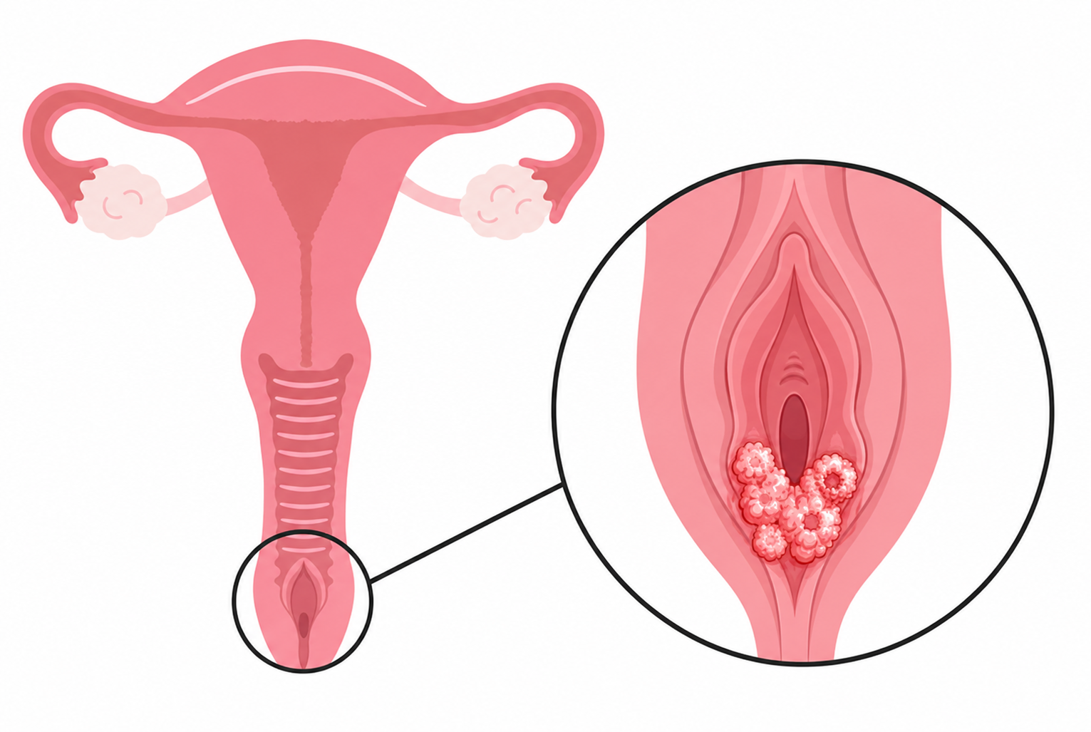 vulvar cancer